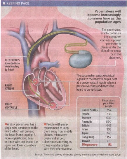pacemaker prevents strokes