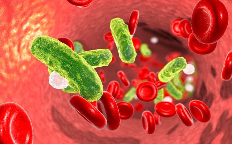 ​​Sepsis: What Causes It?