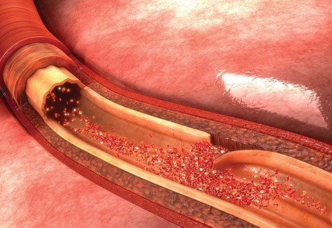 Tear in Aorta