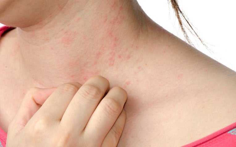 Chronic Skin Disorder: Eczema - Doctor Q&A