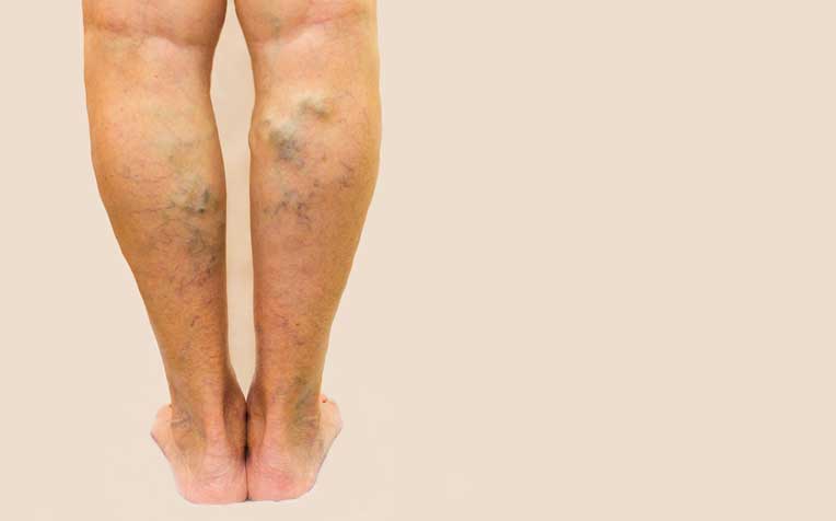 What Are Varicose Veins?