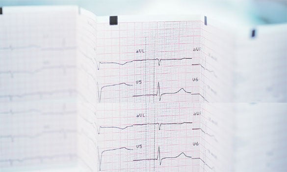 Transcatheter aortic valve implantation (TAVI) – An alternative treatment - National Heart Centre Singapore