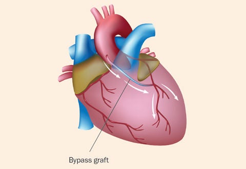 CABG - bypass graft