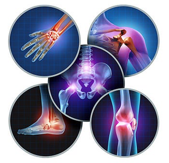 ​​​​How to Prevent Osteoarthritis