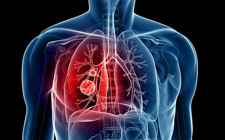 Lung Cancer: Myths and Facts