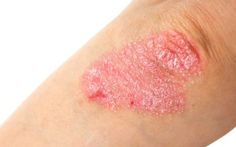 ​​​Psoriasis: Treatment