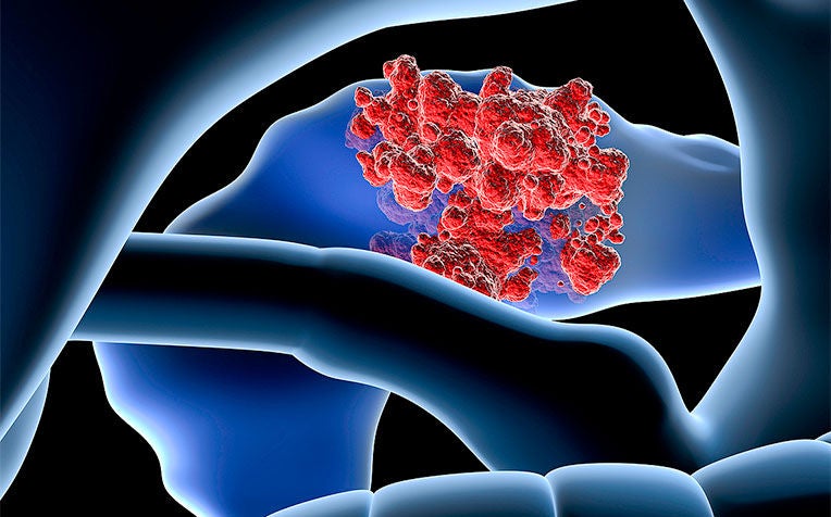 Pancreatic Cancer: Is It Preventable?