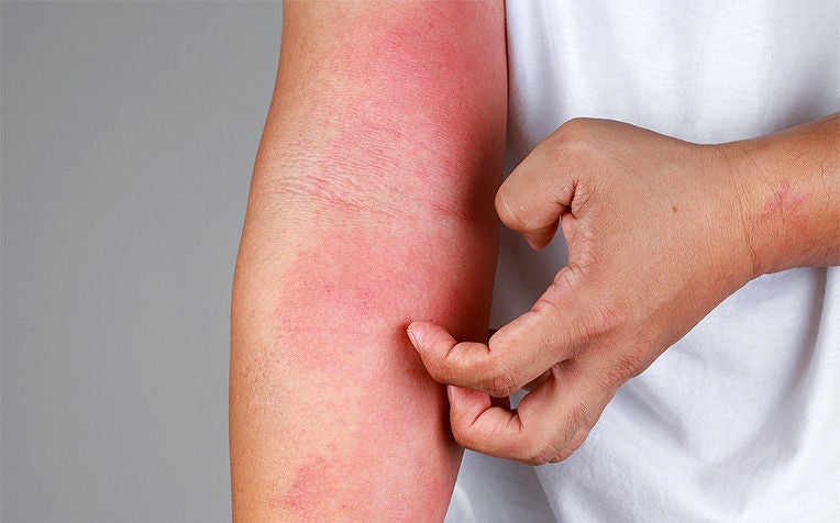 ​How To Prevent Eczema (Atopic Dermatitis)
