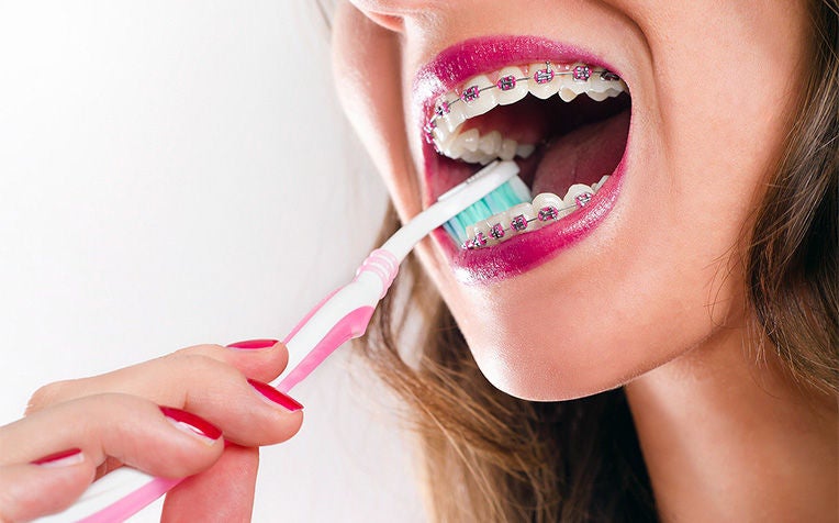 ​Braces: How to Take Care