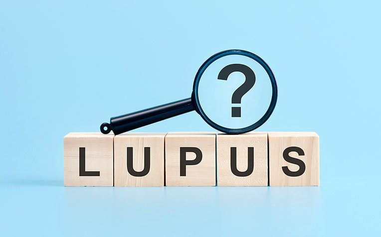 Lupus (Systemic Lupus Erythematosus): What It Is, Symptoms and Who is at Risk