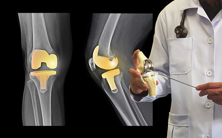 Knee Osteoarthritis Treatment: Surgical Options - HealthXchange