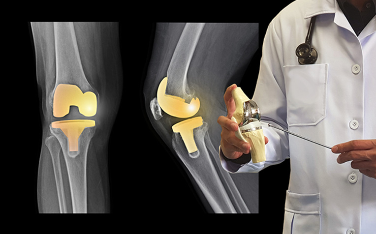 /sites/hexassets/Assets/bones-joints/knee-osteoarthritis-treatment-surgical-options.jpg