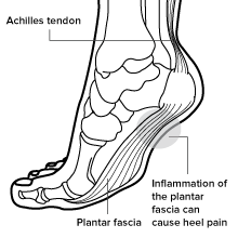 Plantar Fasciitis