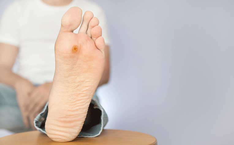 ​​​Plantar Warts (Verrucas): What Is It?