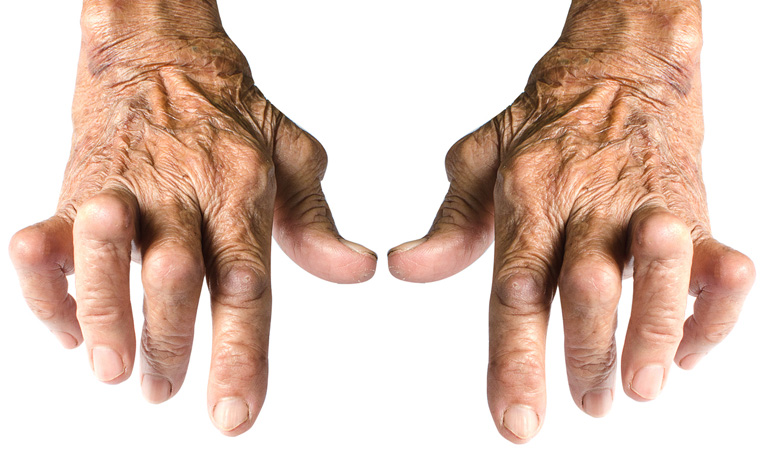 Rheumatoid arthritis