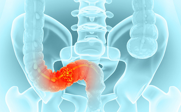 Colorectal Cancer (Colon Cancer): Common Questions Answered!