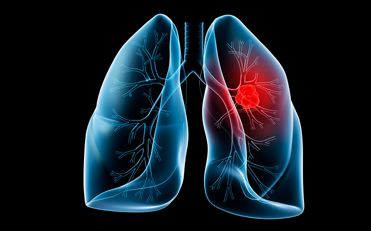 Diagnosis and Treatment for Lung Cancer