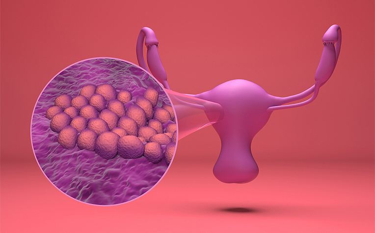 ​Endometrial Cancer (Uterine Cancer) Prevention and Treatment 