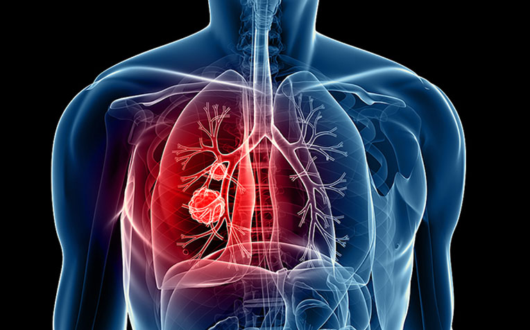 Lung Cancer: Myths and Facts