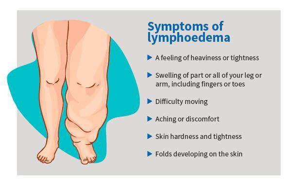 Lymphatic Drainage Massages Can Help Reduce Lymphoedema Swelling