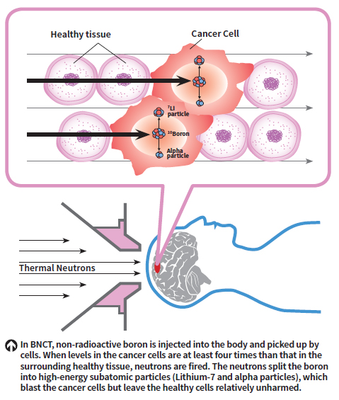 BNCT targets only the cancerous cells, making it safer for patients.