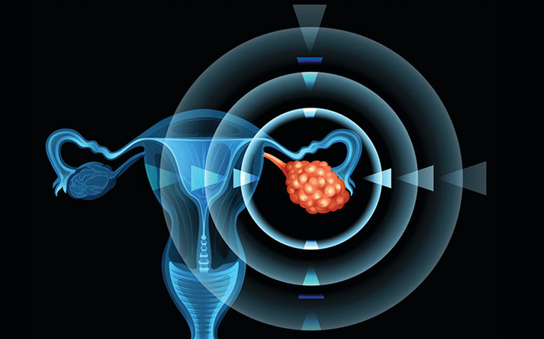  What Causes Ovarian Cancer? 