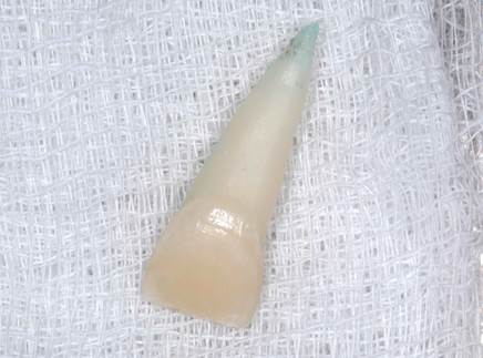 Avulsed tooth