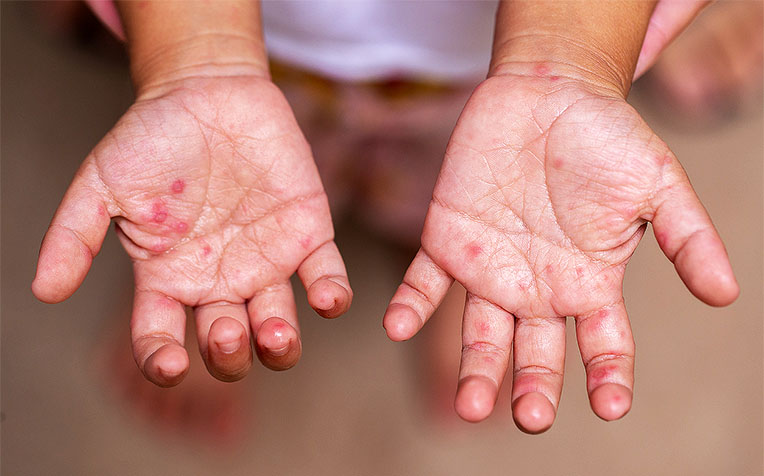 Hand Foot Mouth Disease Hfmd How To