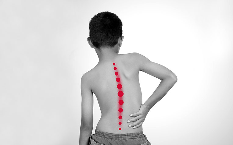 Scoliosis: Causes and Symptoms