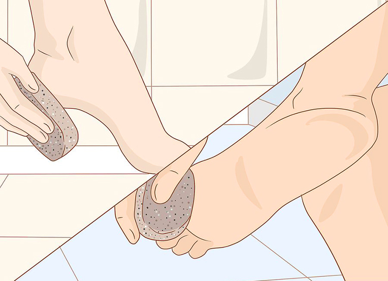 Diabetes Foot Care: How to File Buildup of Hard Skin or Corns -  HealthXchange