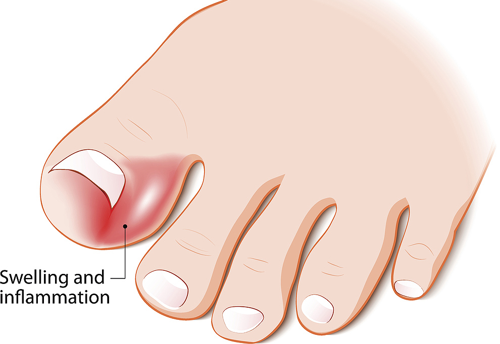 Avoid cutting the sides of toenails