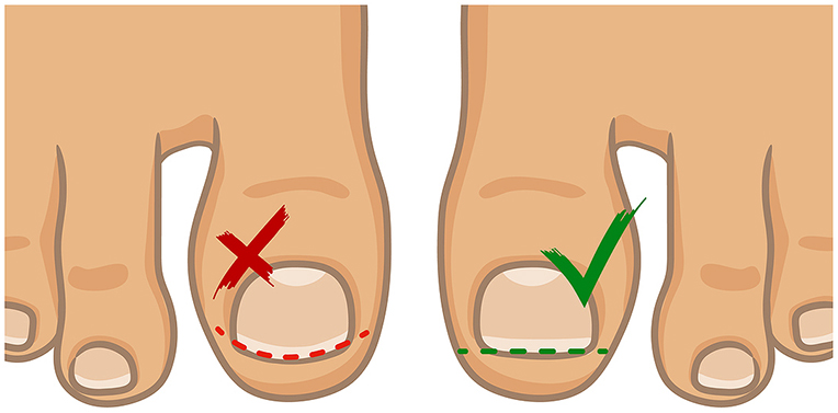 How do I look after my toenails if I have diabetes? - Feel Your Feet