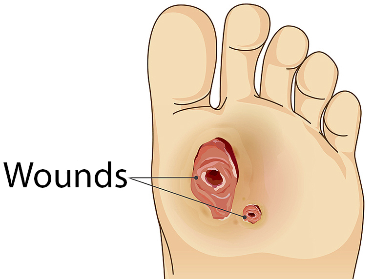 https://www.healthxchange.sg/sites/hexassets/Assets/diabetes/Diabetes%20Foot%20Check%20-%20How%20to%20Check%20Your%20Feet/4.%20Wounds%20(b).jpg