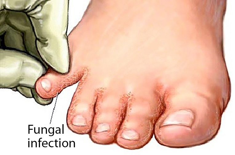 Fungal infection