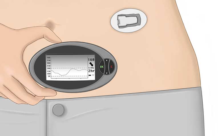 Continuous glucose monitoring solutions