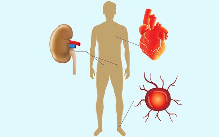 /sites/hexassets/Assets/diabetes/diabetes-complications-kidney-nerve-heart-blood-vessel-diseases.jpg