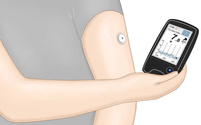 Onderhandelen Overleven straf Features of Flash Glucose Monitoring - HealthXchange