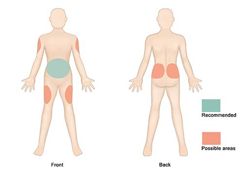 Insulin Injection Rotation Sites Chart