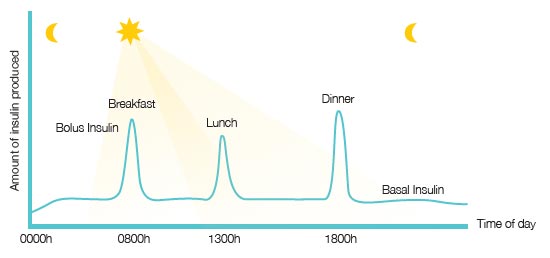 ​​​​​​​​​What Is Type 1 Diabetes?