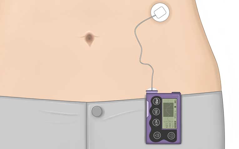 Insulin Pump Therapy: How It Works and Its Advantages - HealthXchange