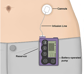 Insulin Pump Therapy: How It Works and Its Advantages - HealthXchange
