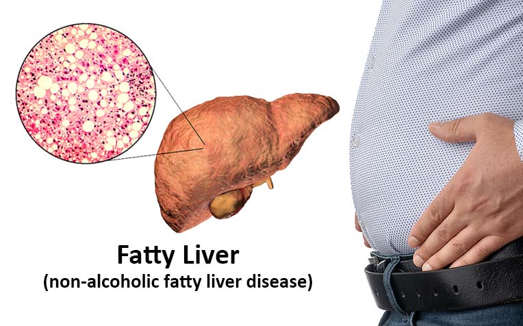 Fatty Liver Disease: Causes, Symptoms and How to Reverse