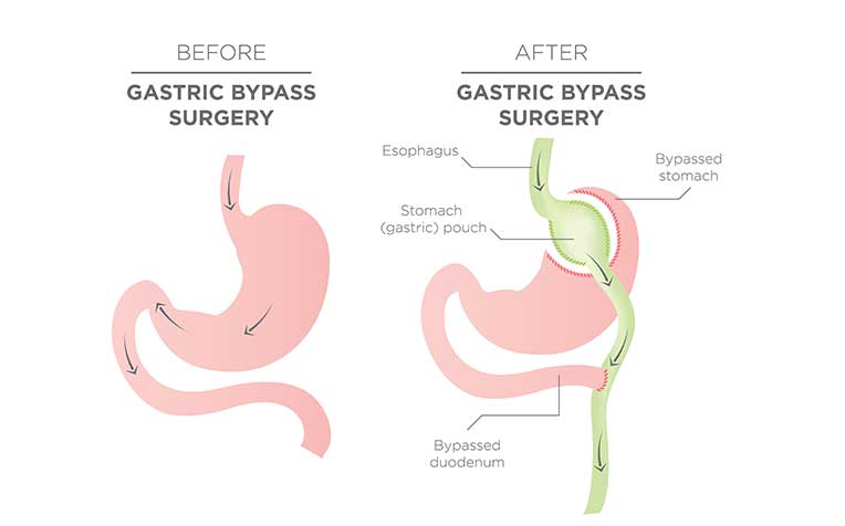 /sites/hexassets/Assets/digestive-system/gastric-bypass-lose-weight-disease-fight-disease.jpg