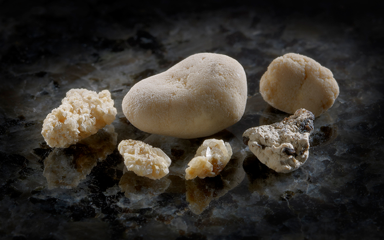  ​What Causes Kidney Stones?