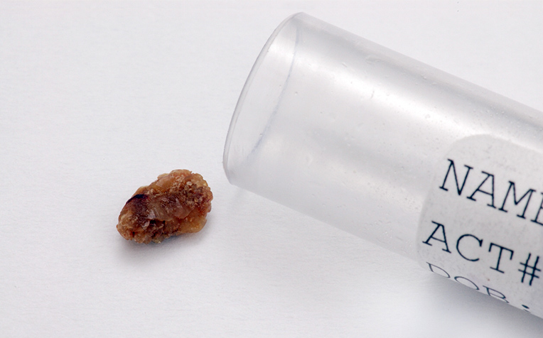 Kidney Stones: How to Prevent and Manage