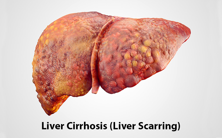 /sites/hexassets/Assets/digestive-system/liver-cirrhosis-causes-risk-factors-b.jpg