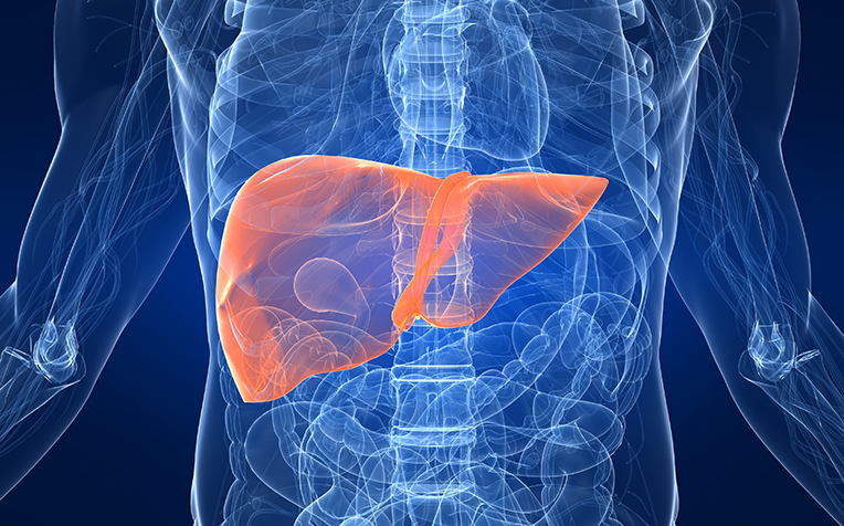 Non-Alcoholic Steatohepatitis (NASH): When a Fatty Liver Gets Inflamed