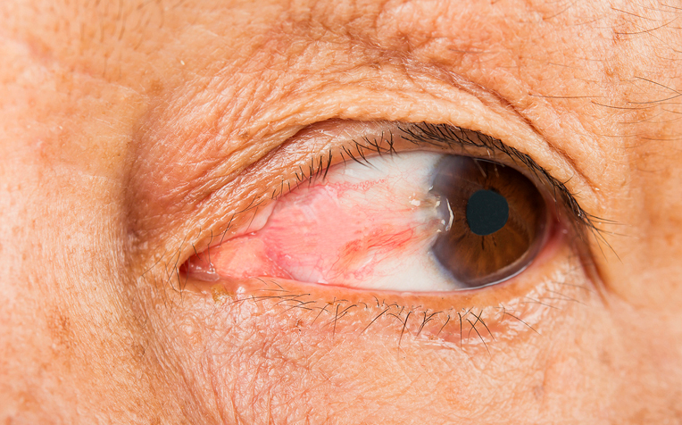 /sites/hexassets/Assets/eye-care/pterygium-fleshy-growth-in-eye-b.jpg