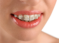 Ceramic Braces