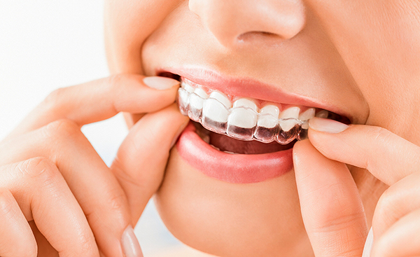 Clear Aligner Therapy